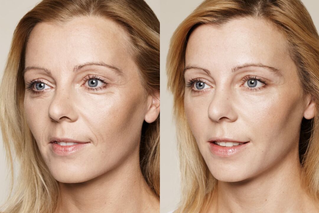 User experience before and after using Valeria's intenskin cream